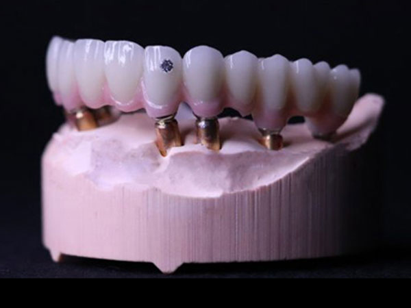 Dental Implants