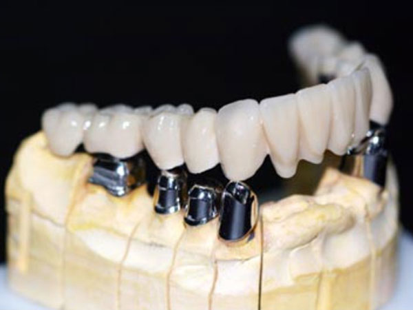 Implant Crown & Bridge