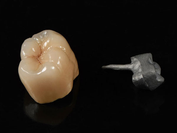 Dental Post and Core