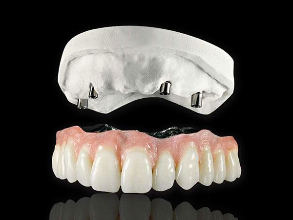 Telescopic Crowns & Bridge