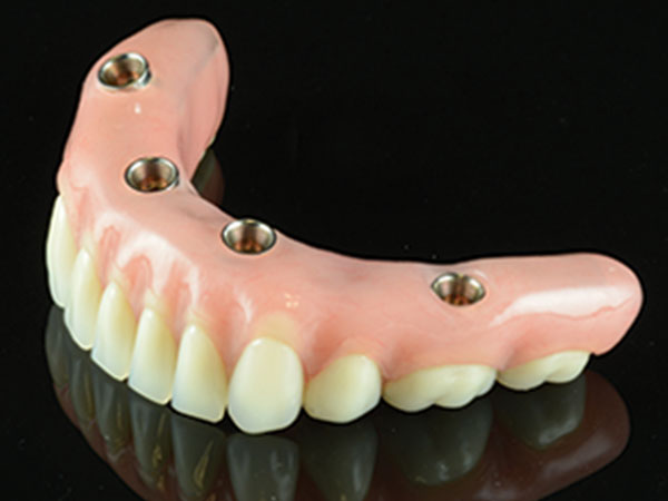 Implant Overdenture