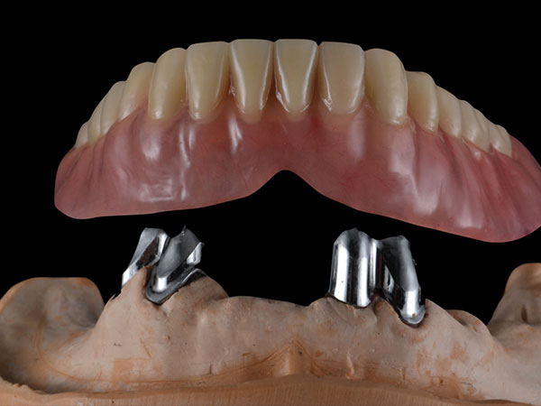 Telescopic Partial Dentures