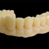 Acrylic Temporary Teeth