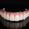 Implant Hybrid Denture