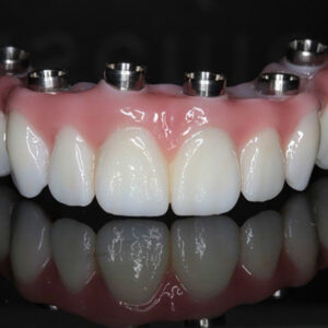 All on 6 Implant
