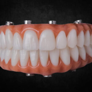 All on Implant
