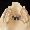 Bonded Palatal Expander