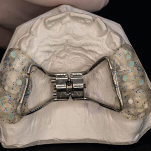 Hyrax Rapid Palatal Expander