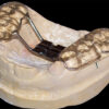 Bonded Palatal Expander