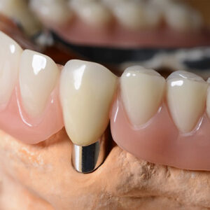 Cobalt chrome Telescopic Crowns