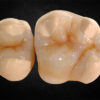 Composite dental Inlay