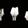 Custom Abutment