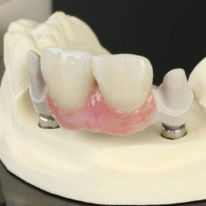 Custom Abutment