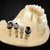 Custom Abutment