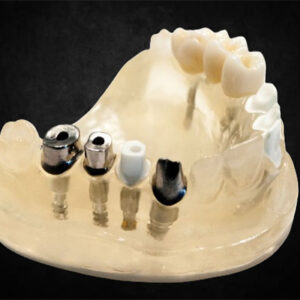 Custom Abutment