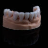 E.max Veneers