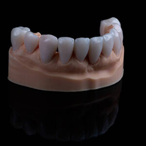 E.max Veneers