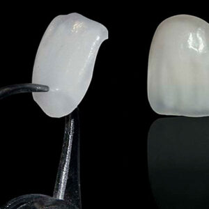 E.max Veneers