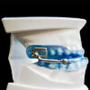 Herbst Oral Appliance