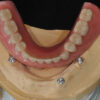 Implant Hybrid Denture