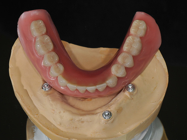 Implant Hybrid Denture