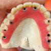 Implant Hybrid Denture