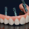 Implant Hybrid Denture