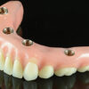 Implant Overdenture