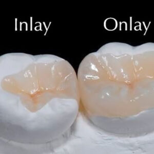 Inlay and Onlay