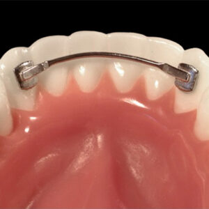 Lingual Wire Retainer