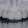 PMMA Temporary Teeth