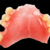 Partial Acrylic Denture