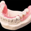 Partial Acrylic Denture