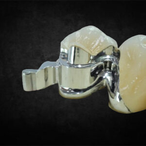 Preci vertix dental attachment