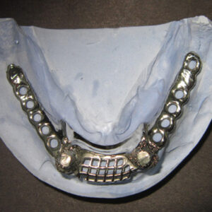 Stud snap dental Attachment
