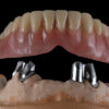 Telescopic Partial Dentures