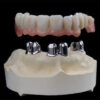 Telescopic Partial Dentures