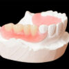 Partial Acrylic Denture