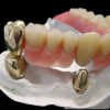 Yellow Gold Telescopic Crowns