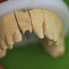 Zirconia Post & Core