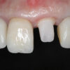 Zirconia Post & Core