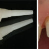 Zirconia Post & Core