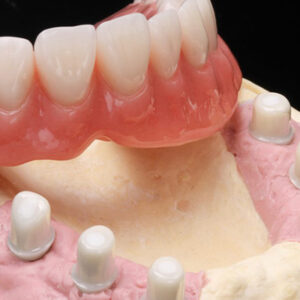 Zirconia Telescopic Crowns