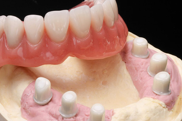 Zirconia Telescopic Crowns