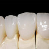 Zirconia Telescopic Crowns