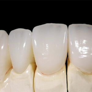 Zirconia Telescopic Crowns