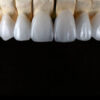 Zirconia Veneers