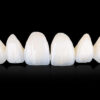 Zirconia Veneers