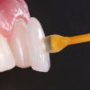 Zirconia Veneers