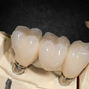 implant crown & bridge